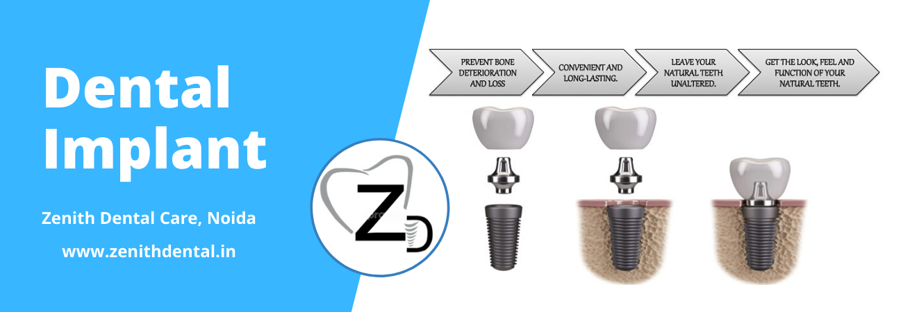 What are the cost of dental implants in Noida?