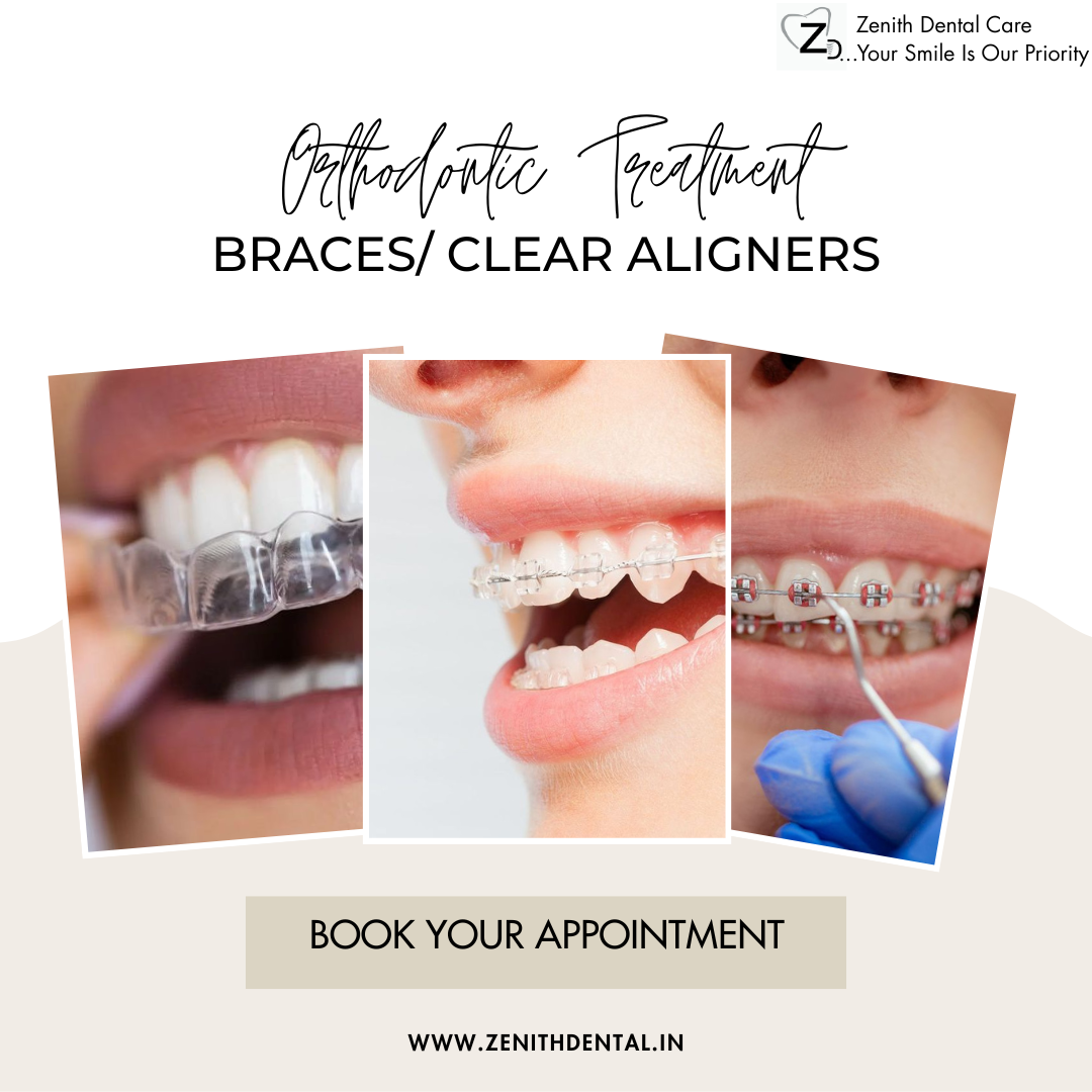 Braces Treatment Near Me: Best Orthodontist in Noida