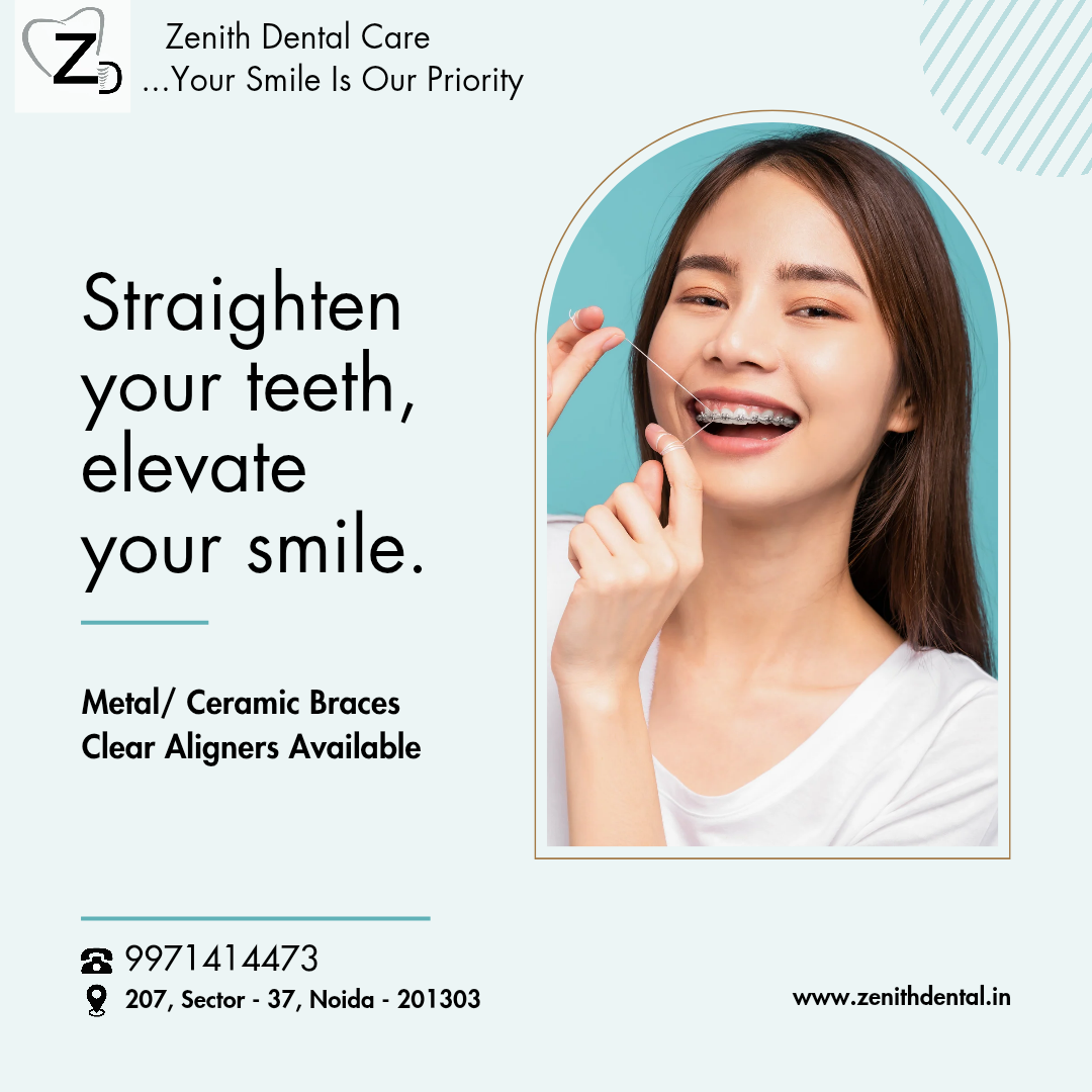 Braces vs Clear Aligners: Which Is Right for You?