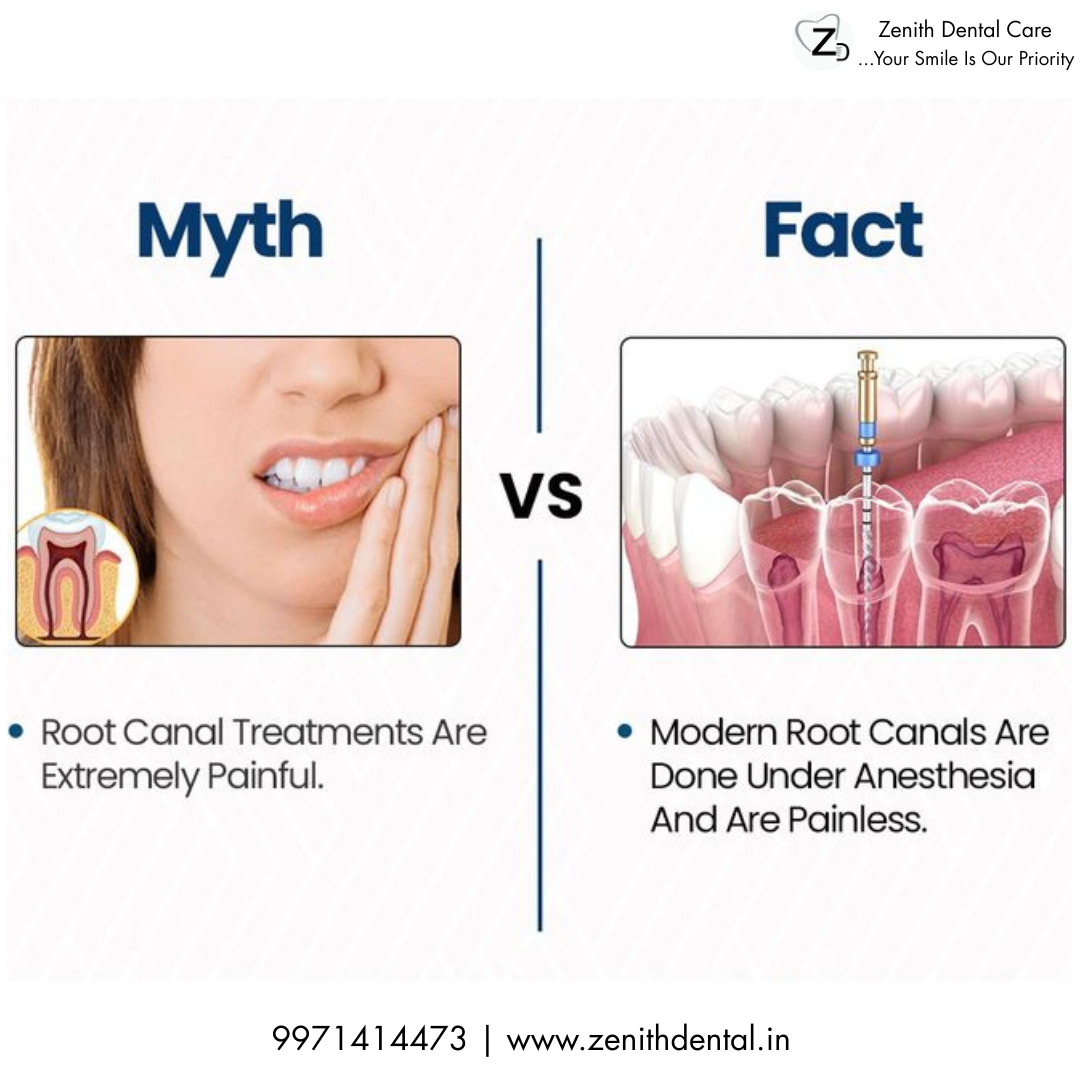 Is Root Canal Treatment Painful? Myths vs Facts