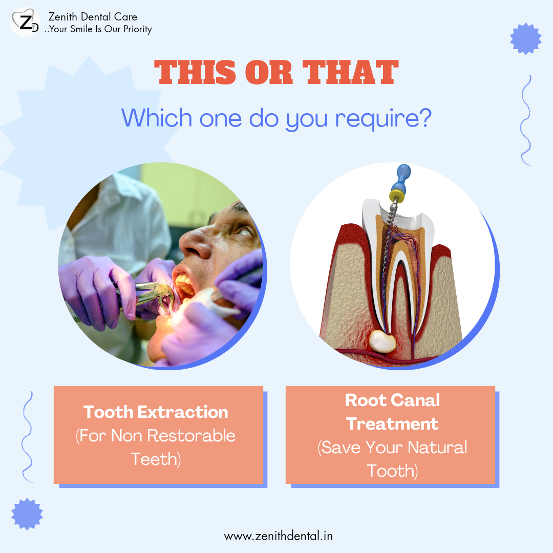 Root Canal Treatment vs Tooth Extraction : The Dilemma