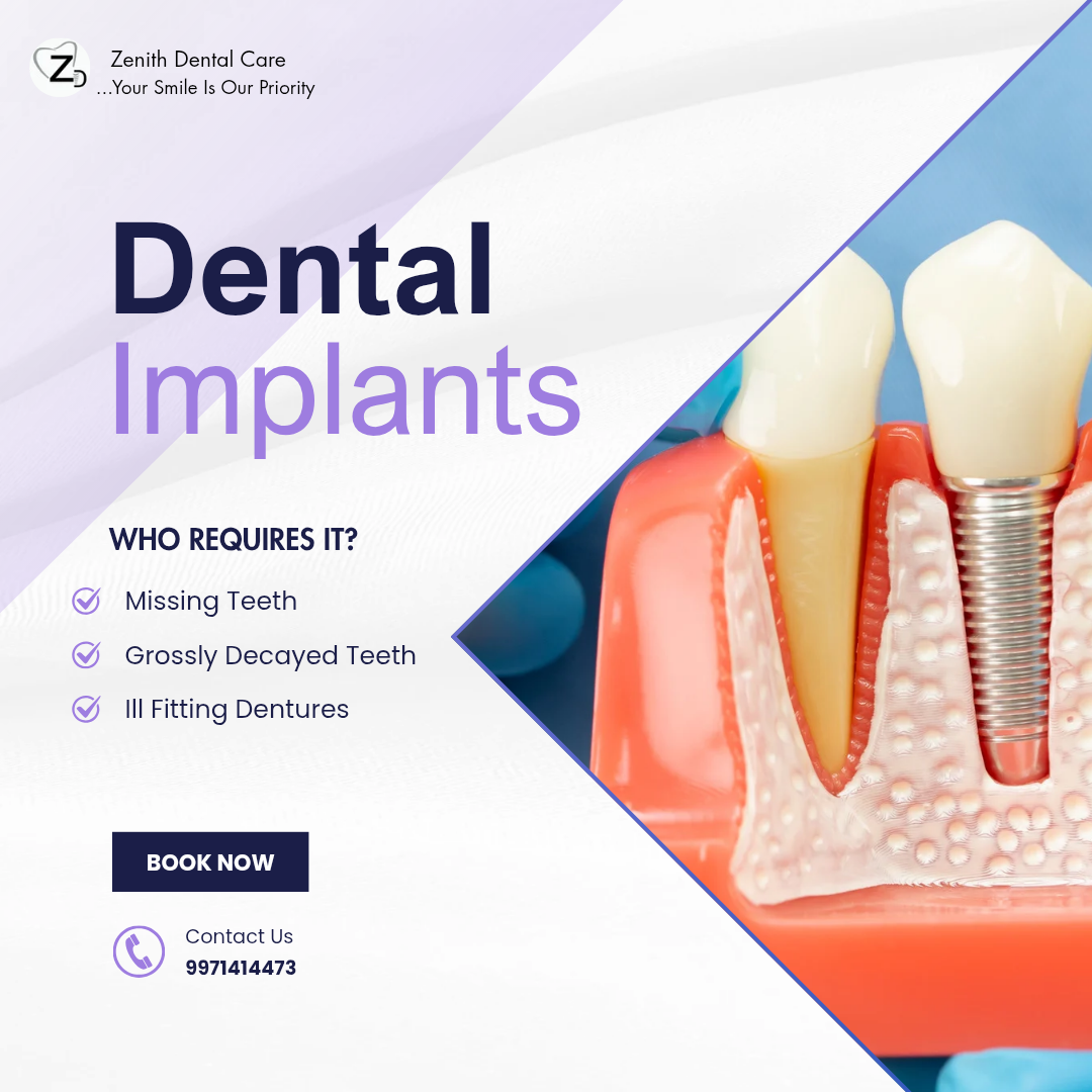 Why Dental Implants for a Single Missing Tooth