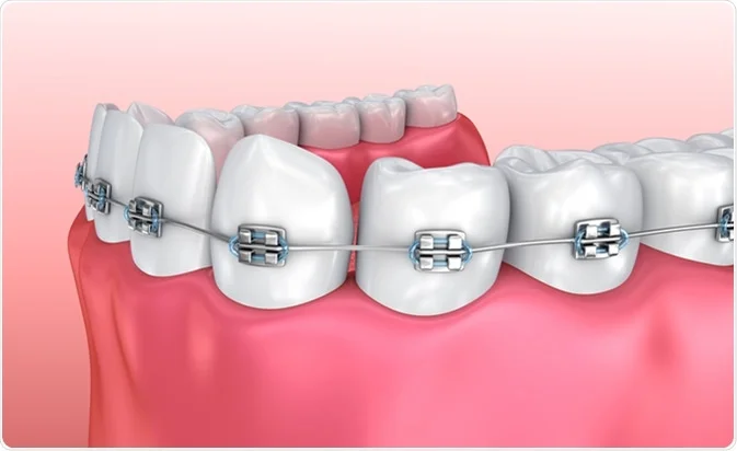 Dental Braces Specialist In Noida Thumbnail