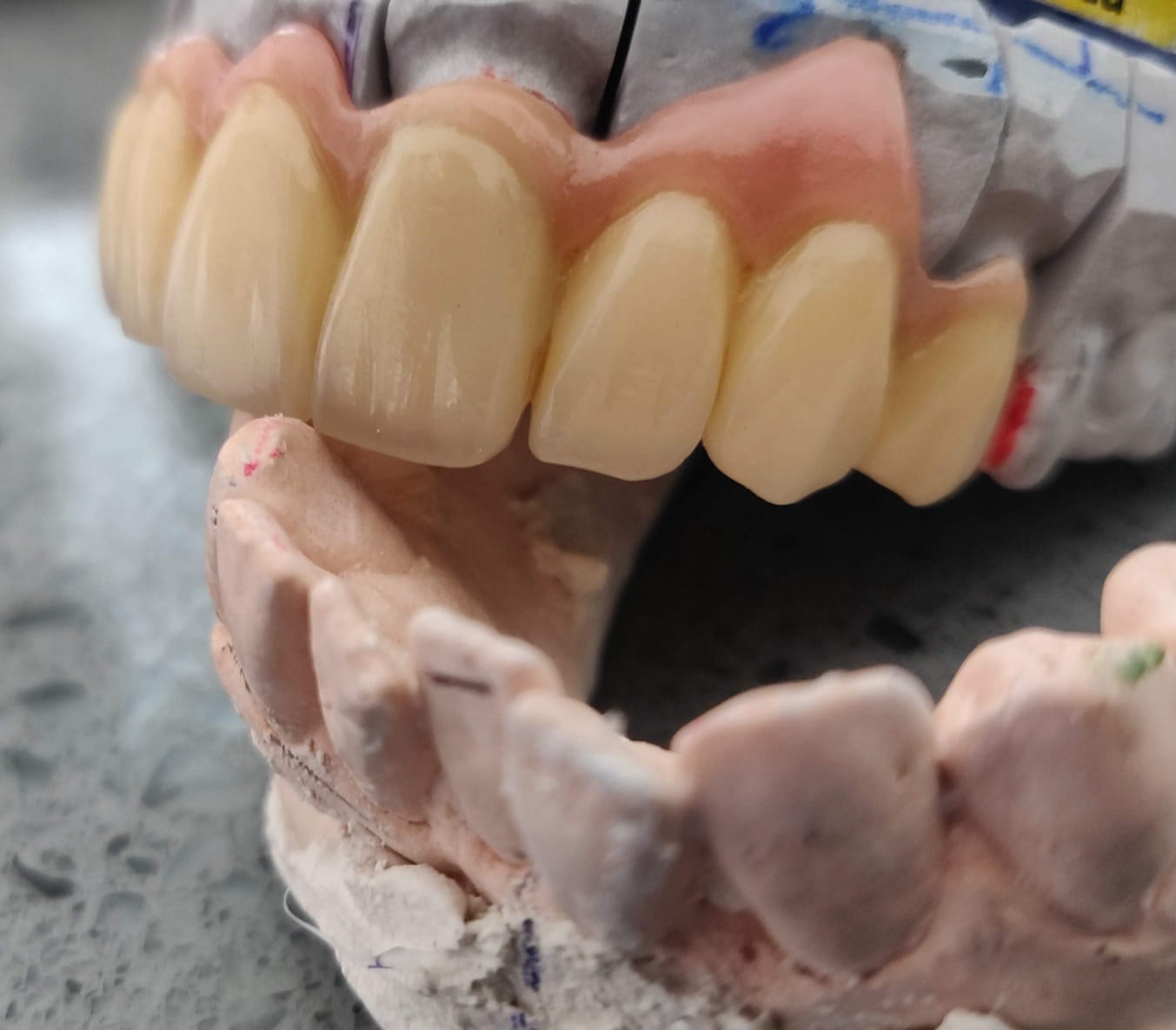 Dental Crowns And Bridge Thumbnail