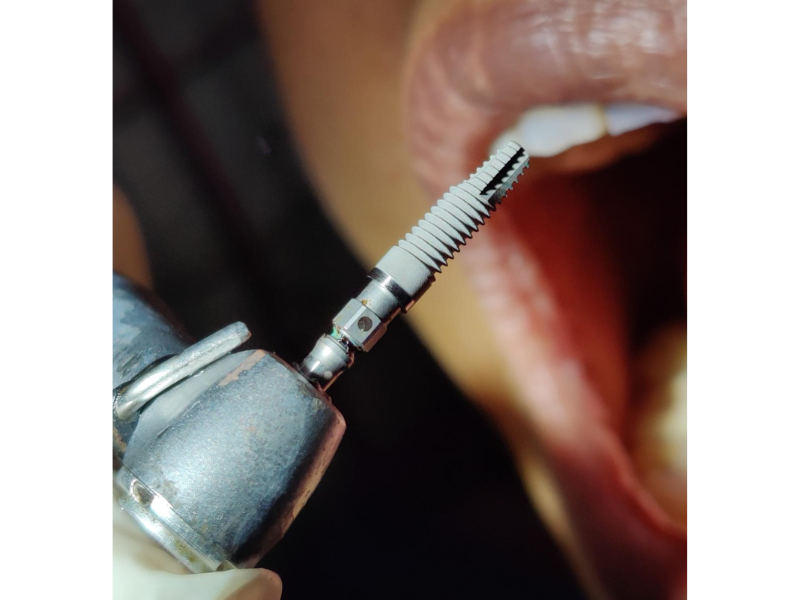 Dental Implants in Noida Thumbnail