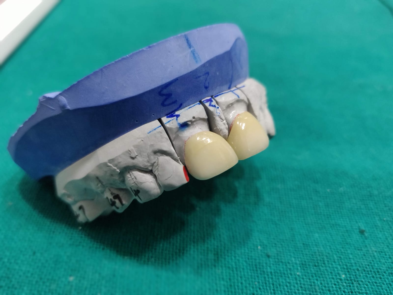 Dental Veneer In Noida Thumbnail