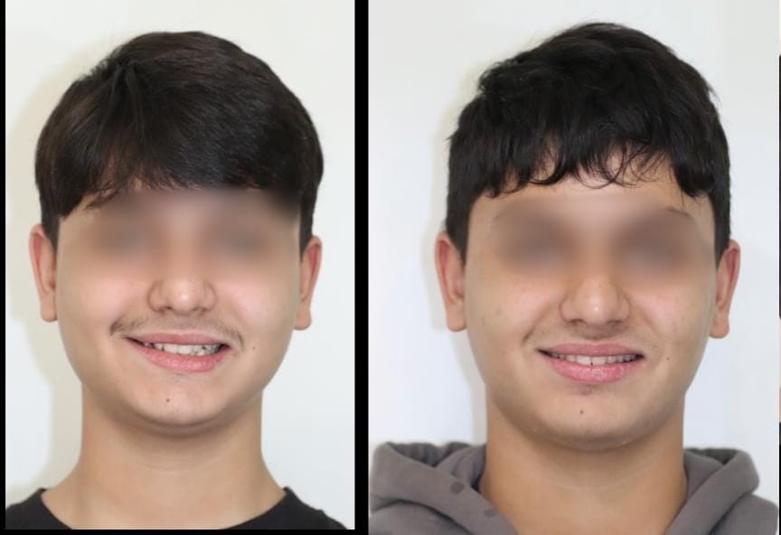 Dental Braces Specialist In Noida Slide