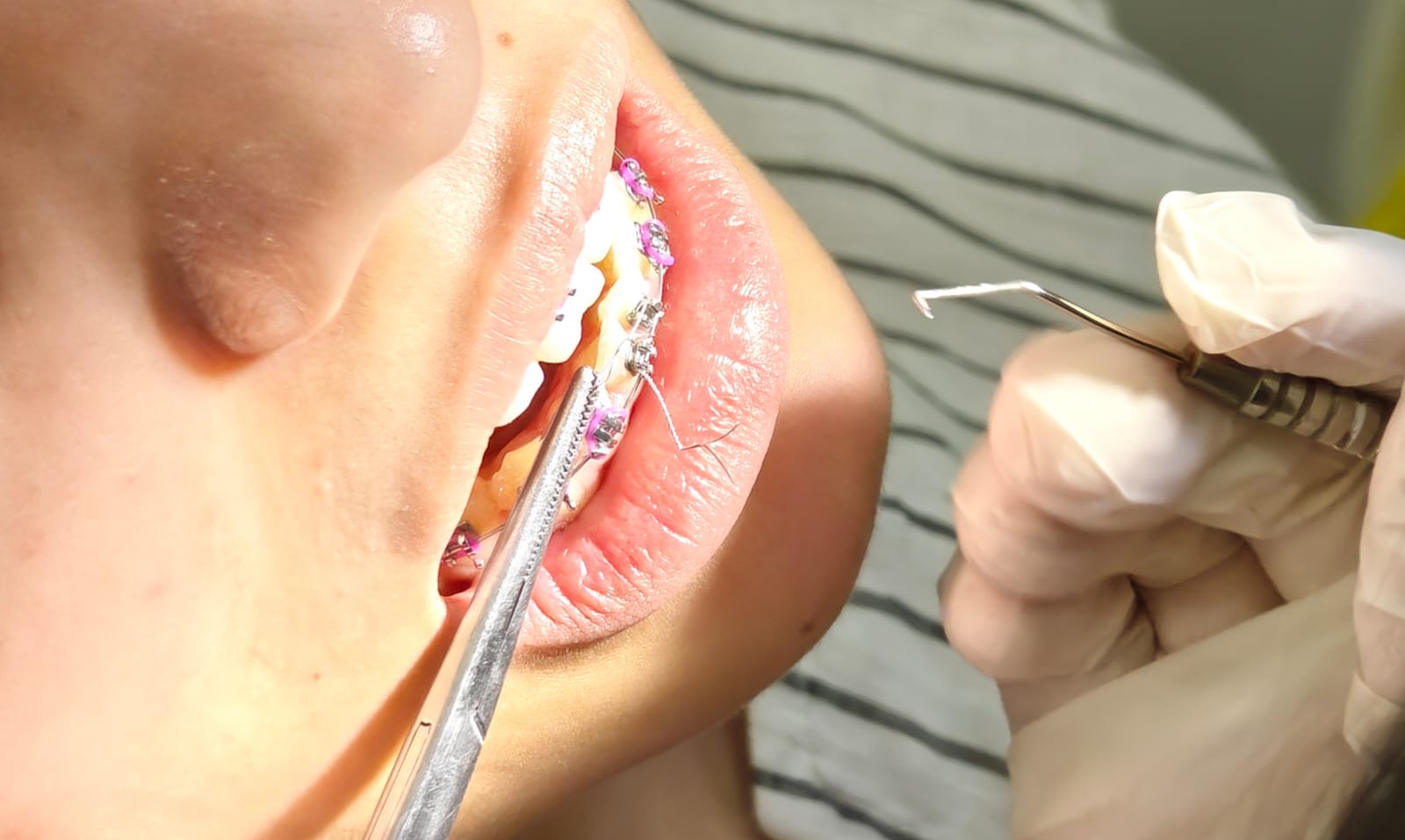 Dental Braces Specialist In Noida Slide