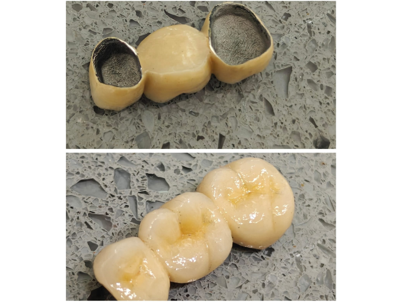 Dental Crowns And Bridge Slide