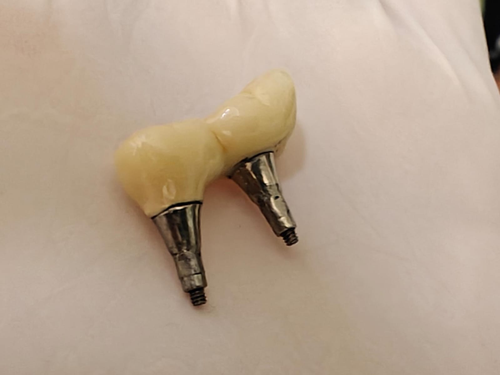 Dental Implants in Noida Slide