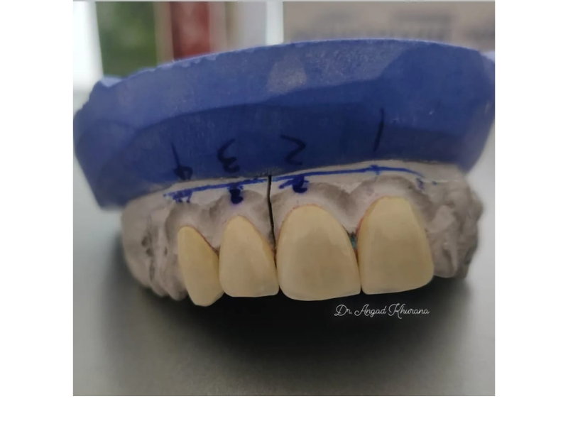 Dental Veneer In Noida Slide