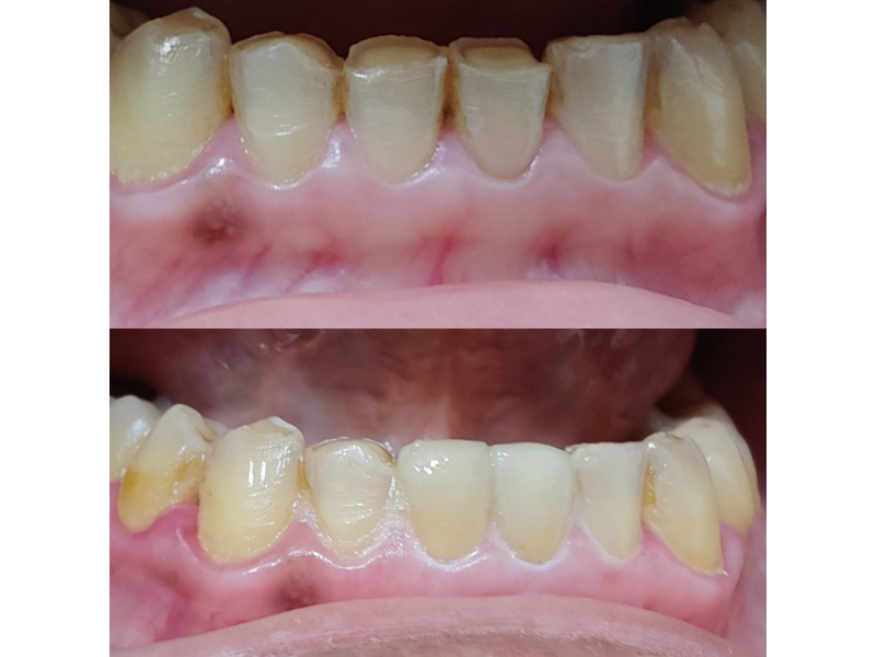 Dental Veneer In Noida Slide