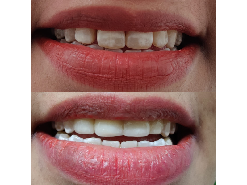Dental Veneer In Noida Slide