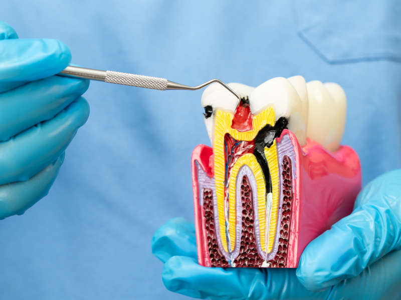 Root Canal Treatment Slide