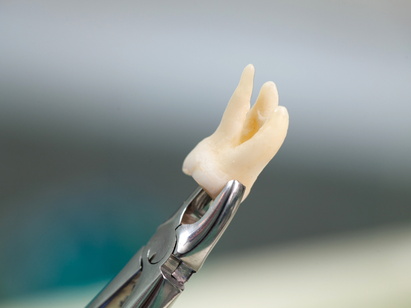 Wisdom Tooth Removal In Noida Slide