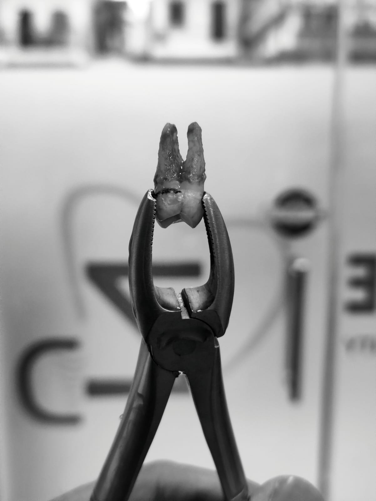 Wisdom Tooth Removal In Noida Slide