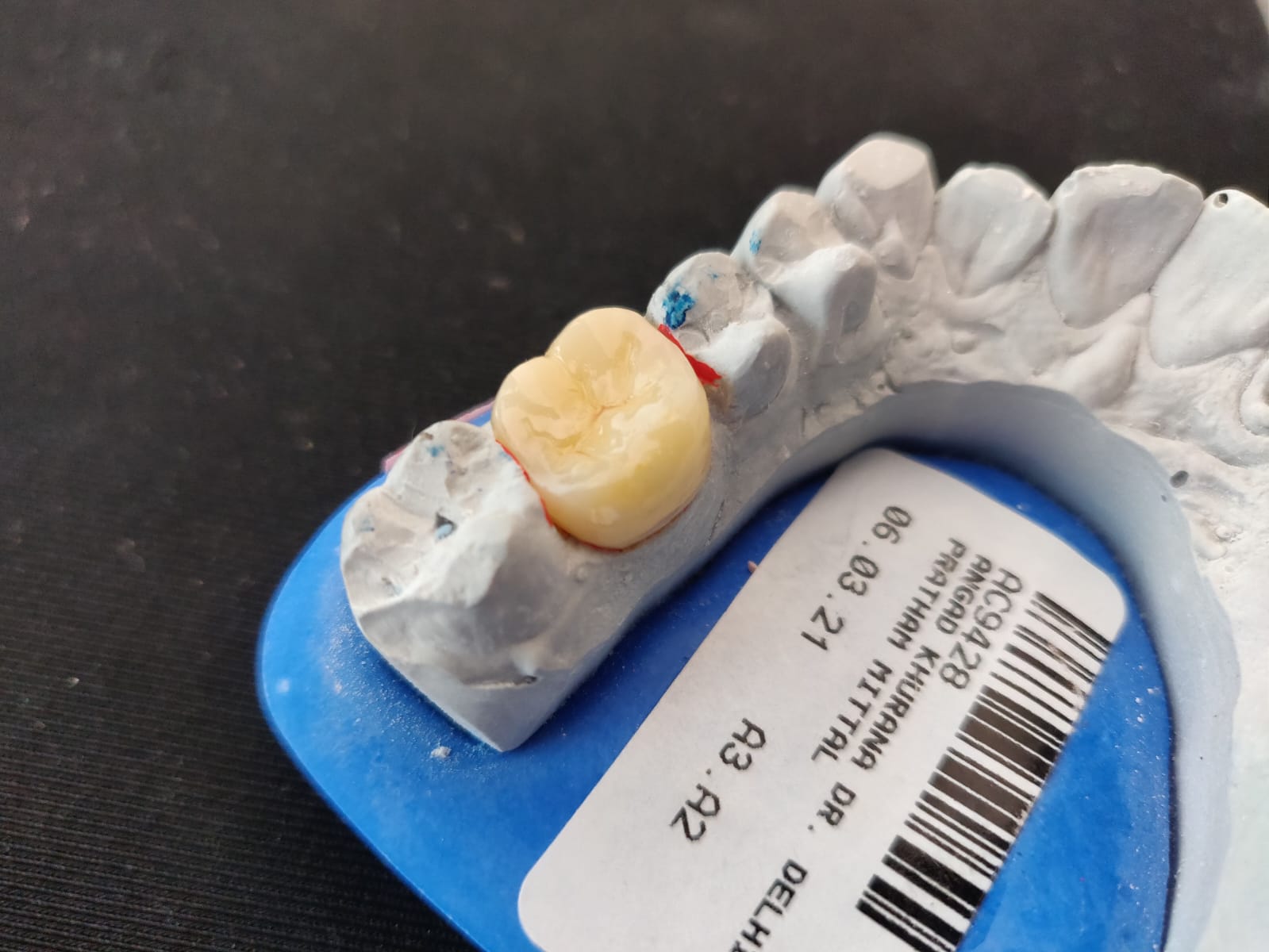 Dental fillings , Dental Crowns And Dentures Slide