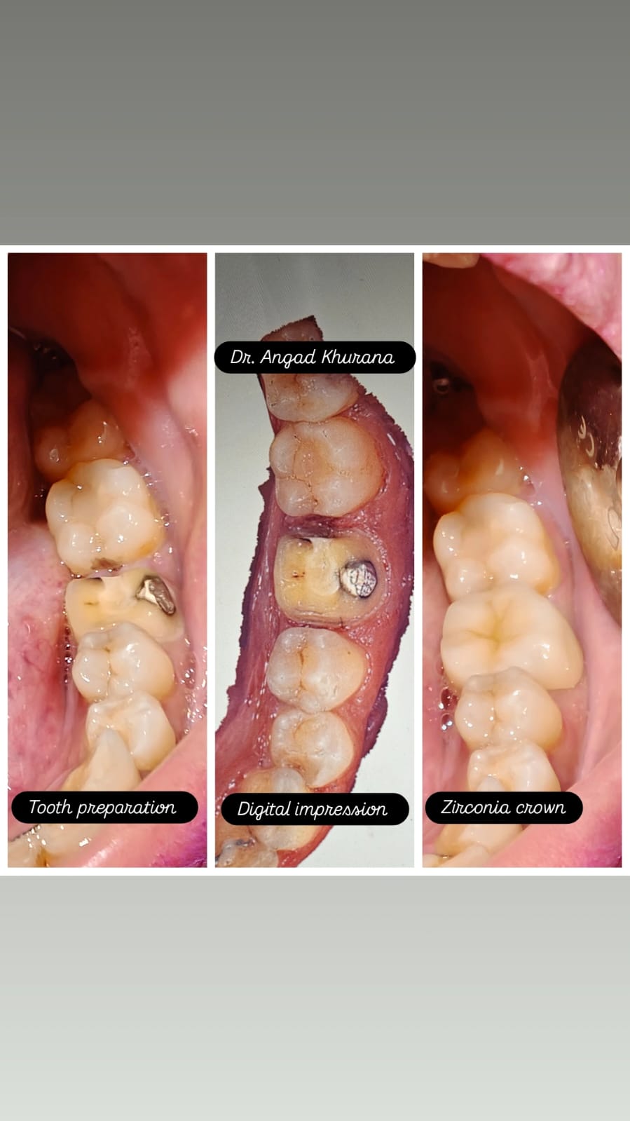 Dental fillings , Dental Crowns And Dentures Slide