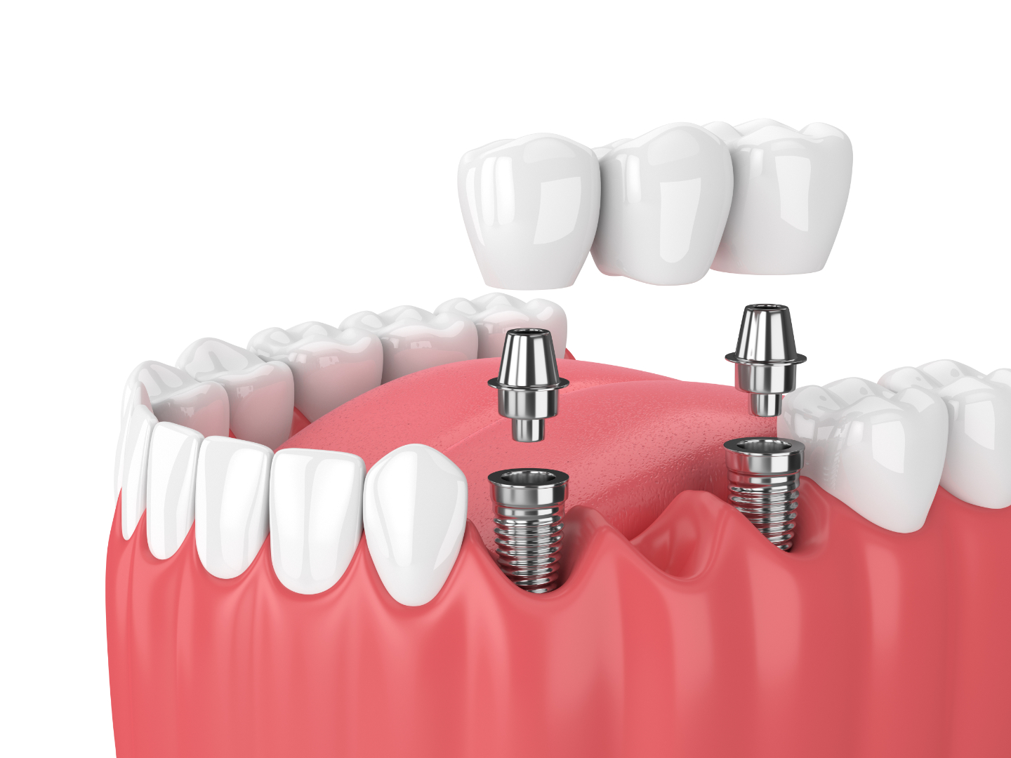Dental Implants Thumbnail