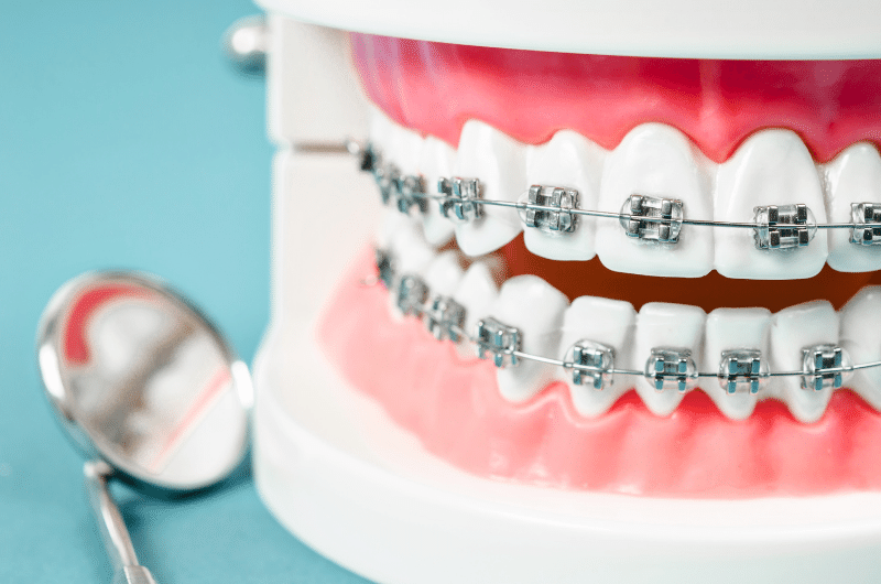 Dental Braces Treatment Thumbnail