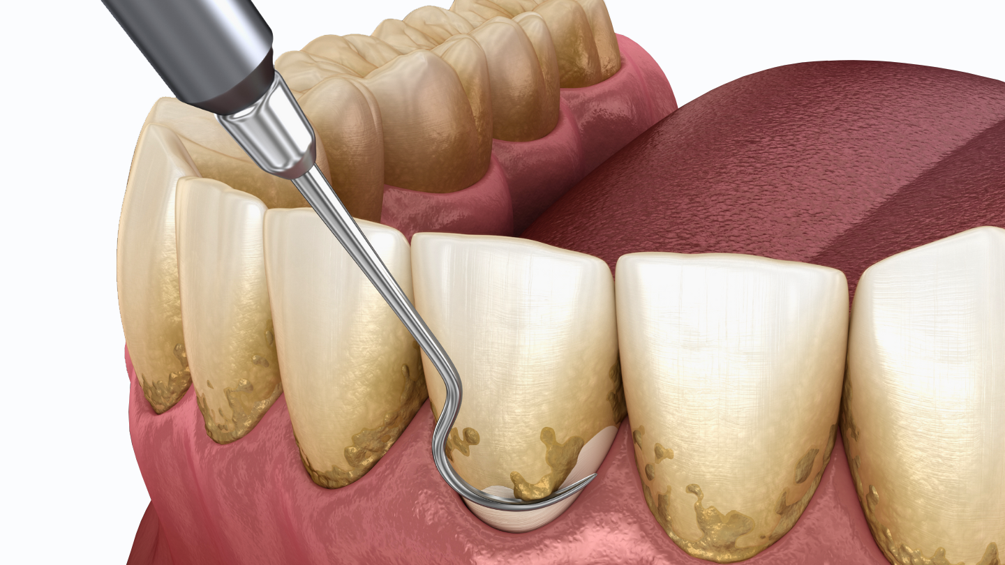 Periodontics Treatments Thumbnail