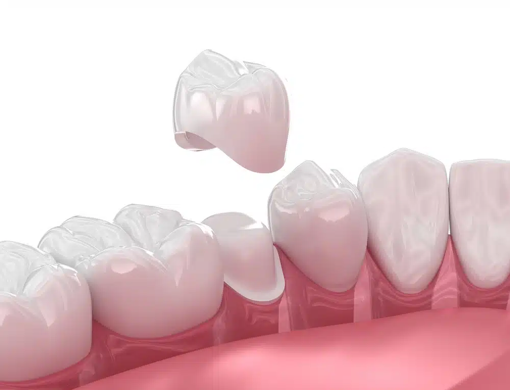 Dental fillings , Dental Crowns And Dentures Thumbnail