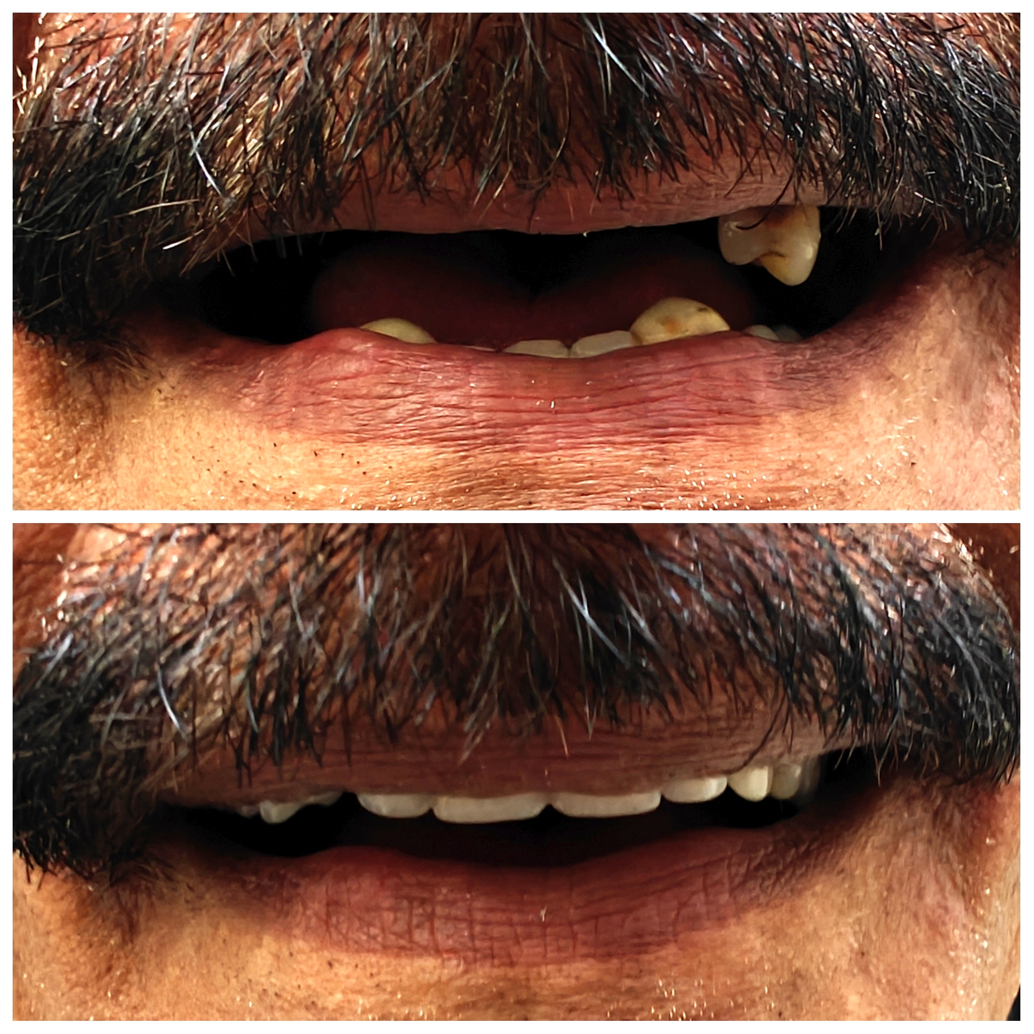 Complete Upper Denture Rehab - Zenith Dental Care