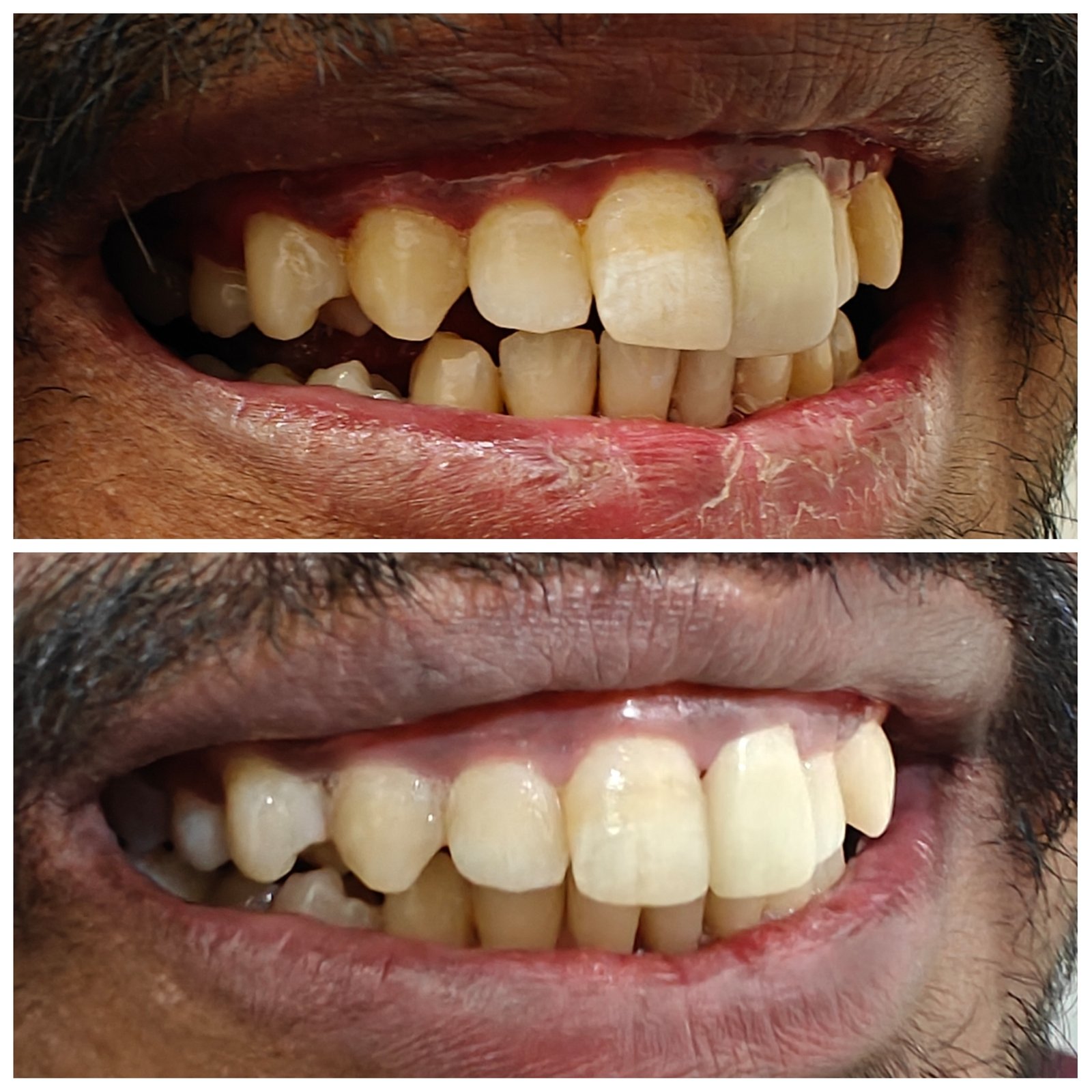 Replacing old faulty crown with zirconia all ceramic  - Zenith Dental Care