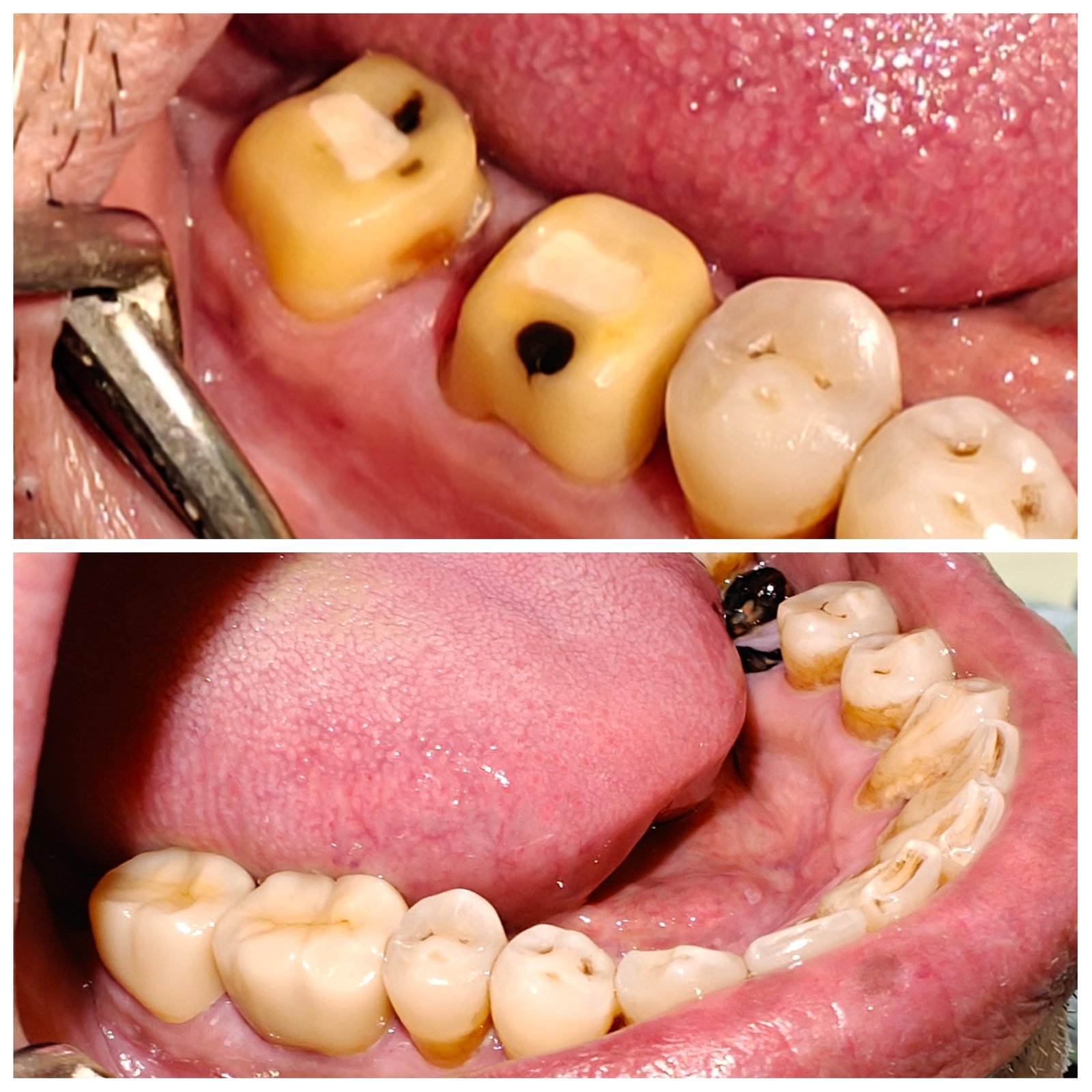 Zirconia Dental Crowns  - Zenith Dental Care