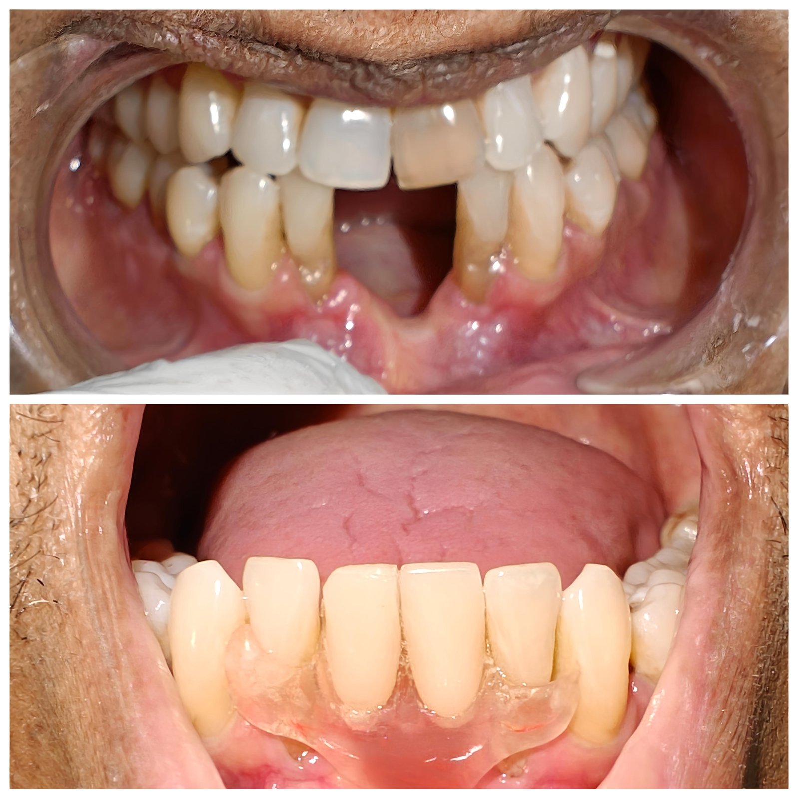 Missing teeth treatment with flexible denture  - Zenith Dental Care