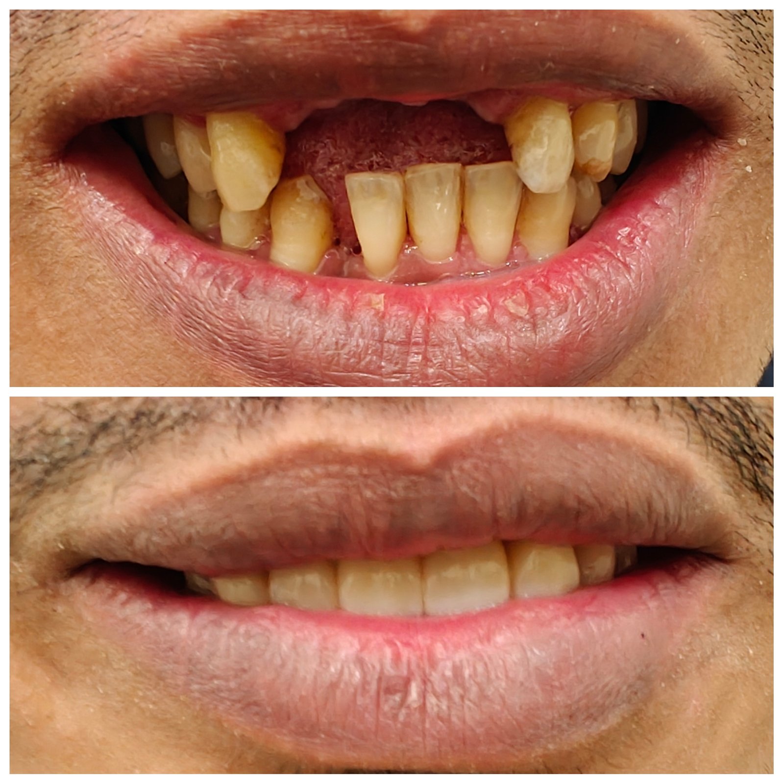 Anterior rehabilitation  - Zenith Dental Care