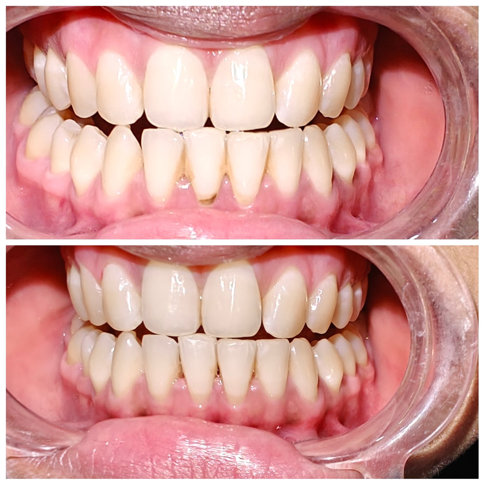 Teeth Cleaning and Polishing in Noida Sector 37  - Zenith Dental Care