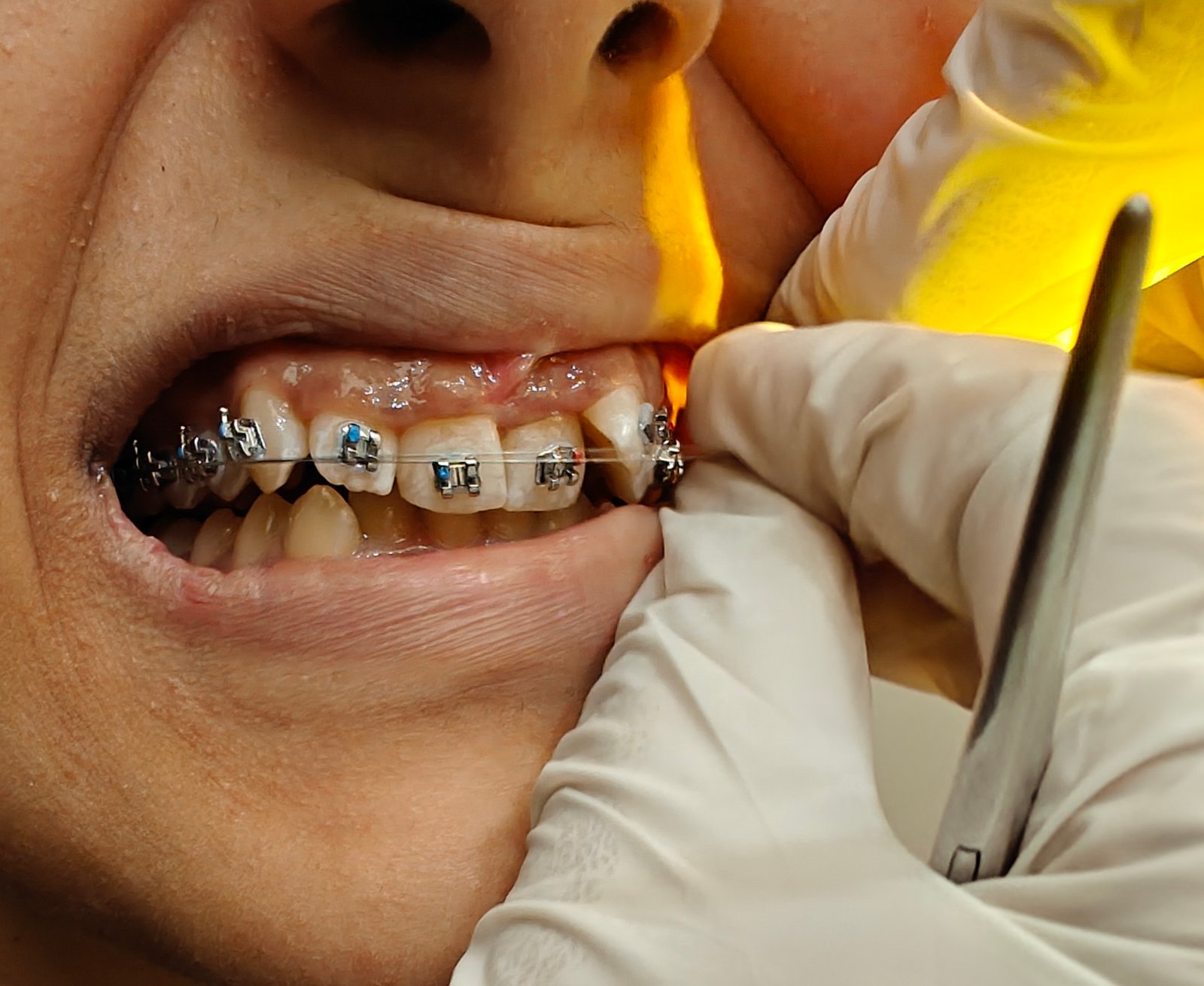 Orthodontic treatment in Noida Sector 37 - Zenith Dental Care