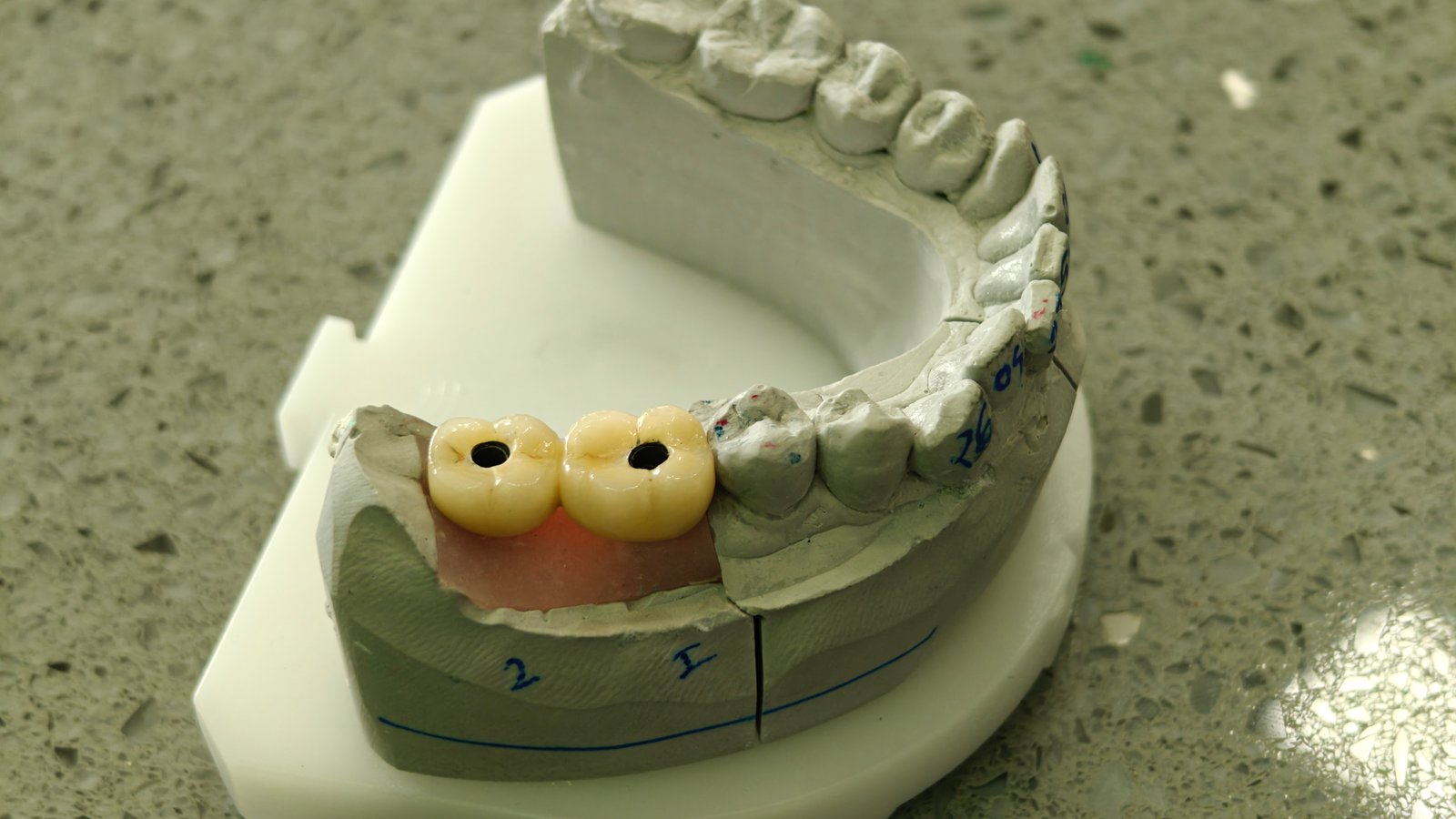 Implant dental crowns in Noida  - Zenith Dental Care