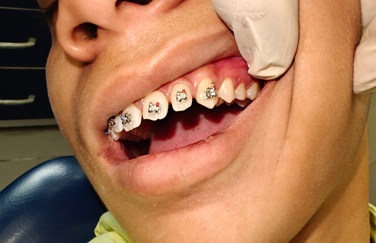 Metal Braces Treatment in Noida  - Zenith Dental Care