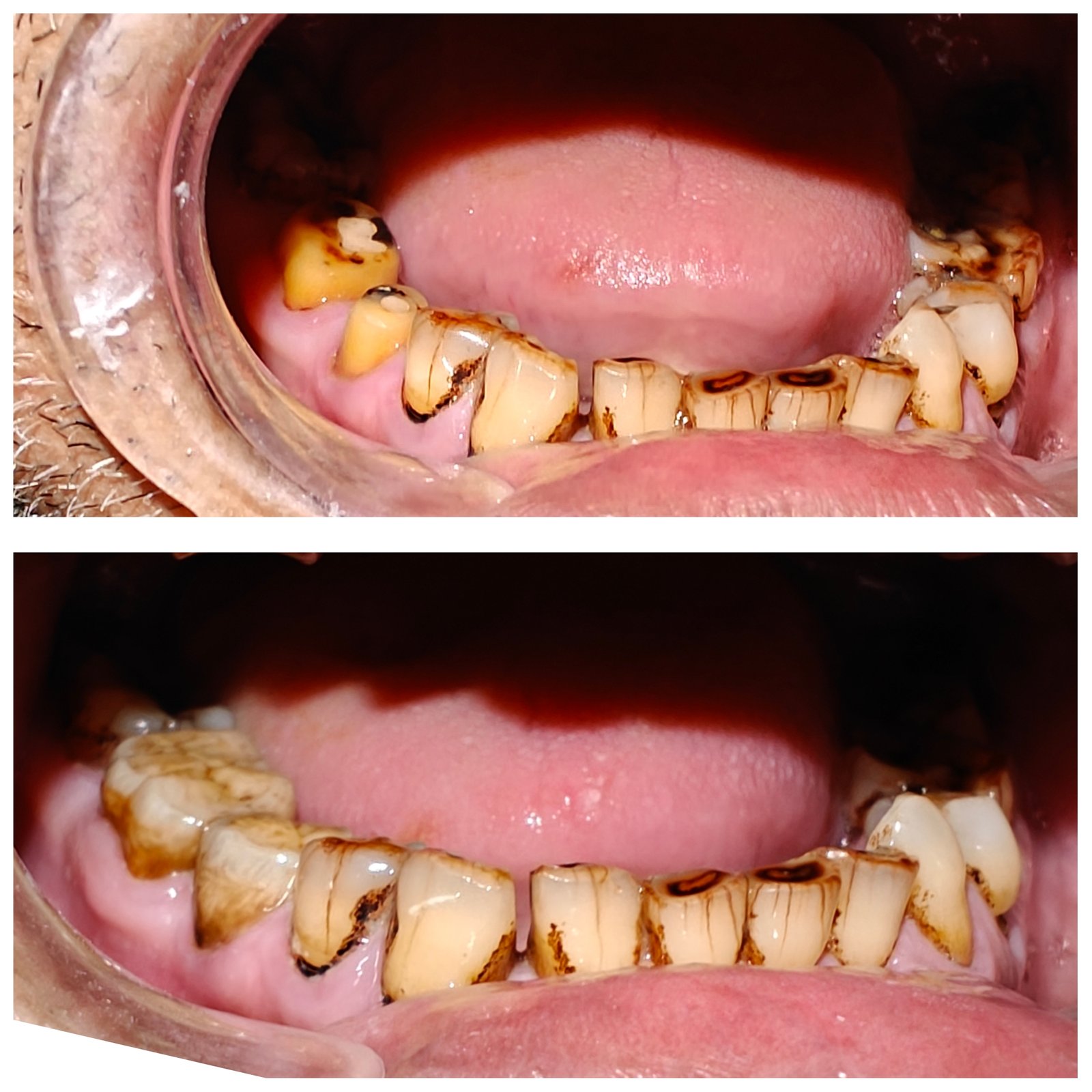Customized zirconia crowns in Noida  - Zenith Dental Care