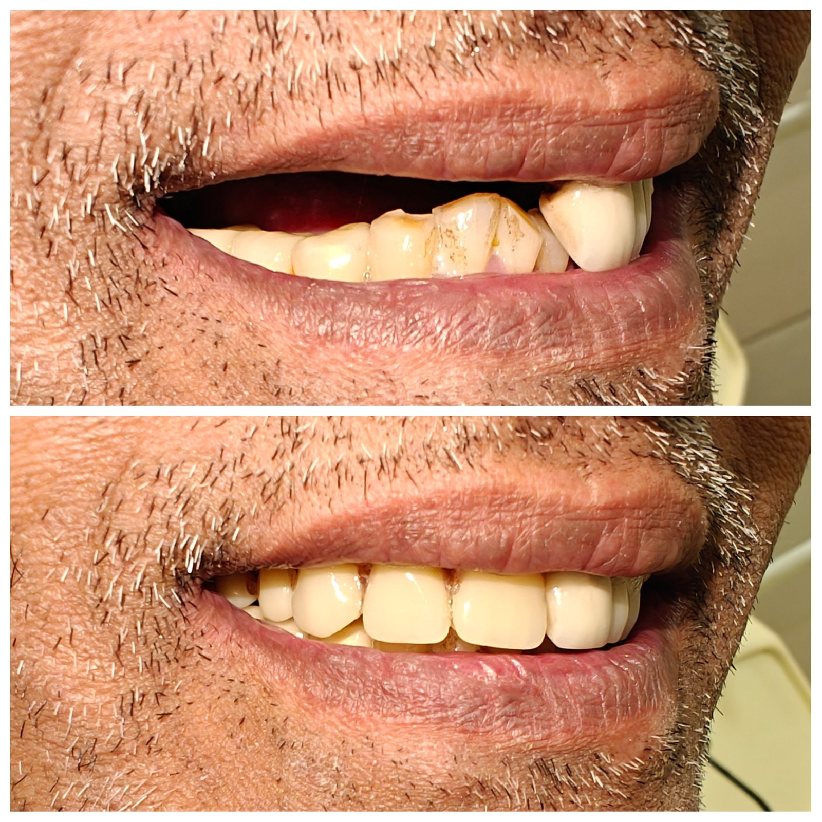 Partial denture teeth replacement  - Zenith Dental Care