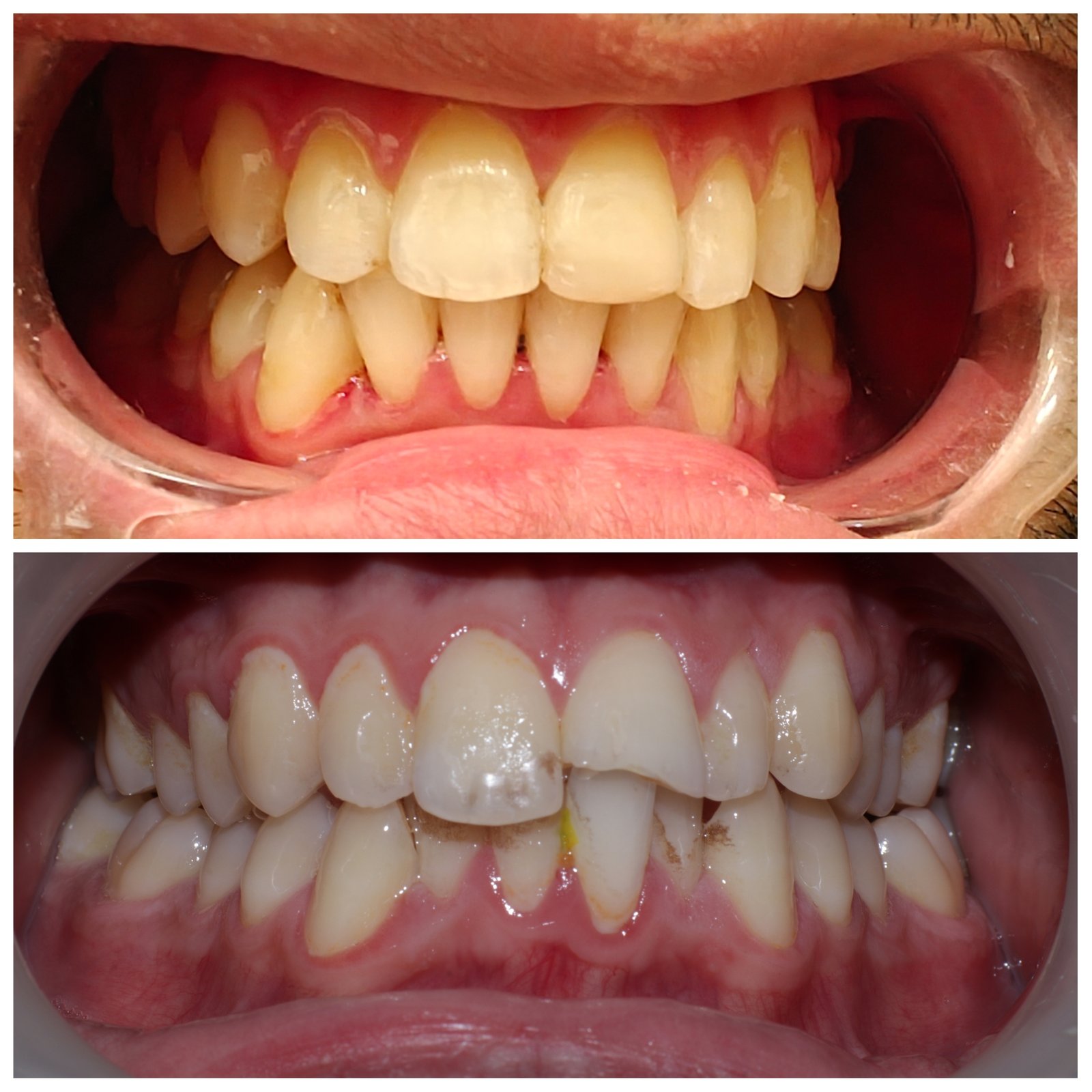 Post orthodontic treatment and chipped tooth repair  - Zenith Dental Care