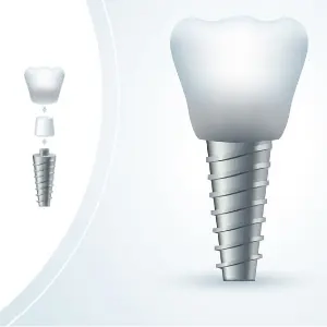 How Dental Implant Look Show In Graphics