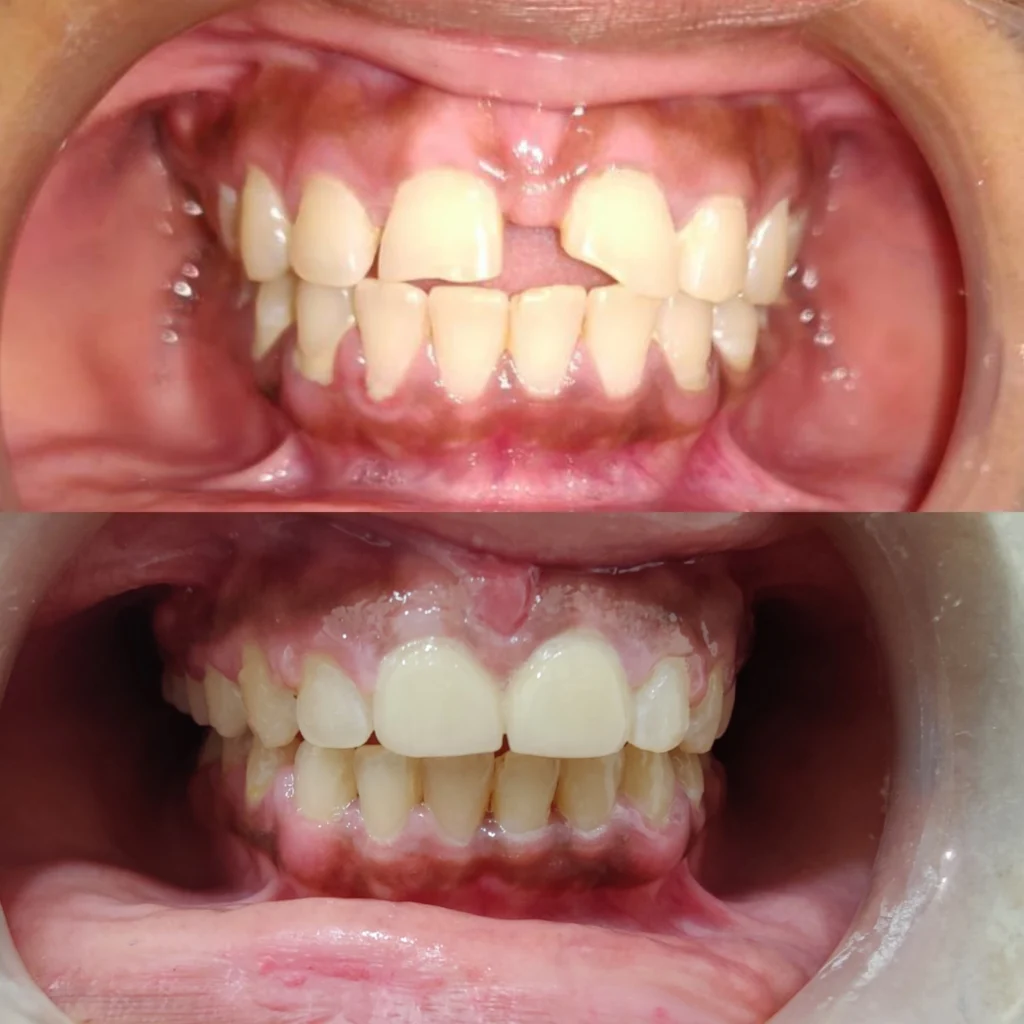 Before and after dental treatment. Crooked teeth and gap in before photo, straight, white teeth with no gap in after photo.