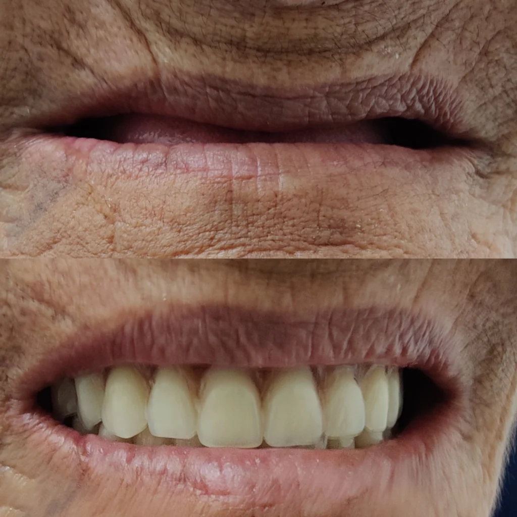 A before and after photo of a patient's smile.