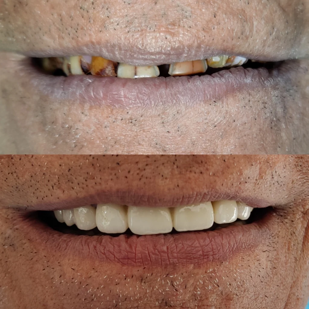 A before and after photo of a patient's smile. The before photo shows the patient with dark, stained teeth. The after photo shows the patient with white, bright teeth.
